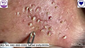 How to Prevent Acne: 14 Tips to Reduce Pimples