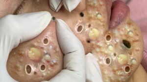 The Euphoria of Removing Blackheads: A Deep Dive into the Relaxing Ritual of Skincare