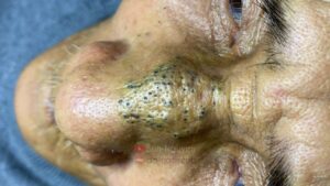 How Many Different Kinds of Facial Blemishes Are There?
