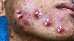Salicylic Acid vs. Benzoyl Peroxide: Which Is Better for Acne?
