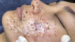 Adult Acne: I’m a Decade Past Puberty — Why Am I Still Breaking Out?